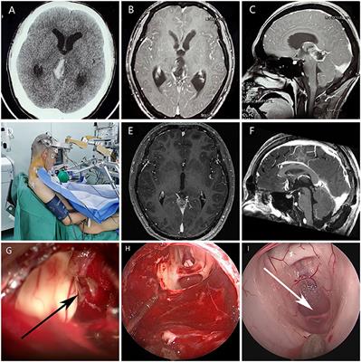 Endoscope-Assisted Microsurgery in Pediatric Cases With Pineal Region Tumors: A Study of 18 Cases Series